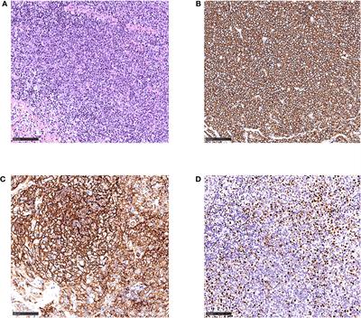 Secondary Hemophagocytic Lymphohistiocytosis With Epstein–Barr Virus-Associated Transformed Follicular Lymphoma: A Case Report and Literature Review